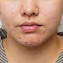 Load image into Gallery viewer, Acne Control Treatment