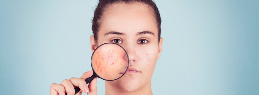 Choosing the Right Acne Cream for Your Skin