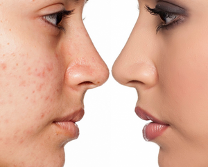 Refine & Clarify Acne Treatment